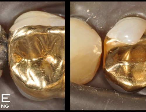Porcelain May Not Be The Only Restorative Material For Your Tooth