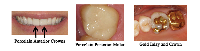 crowns inlays onlays