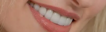 dental veneers
