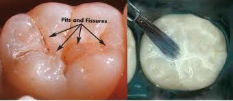 dental sealant
