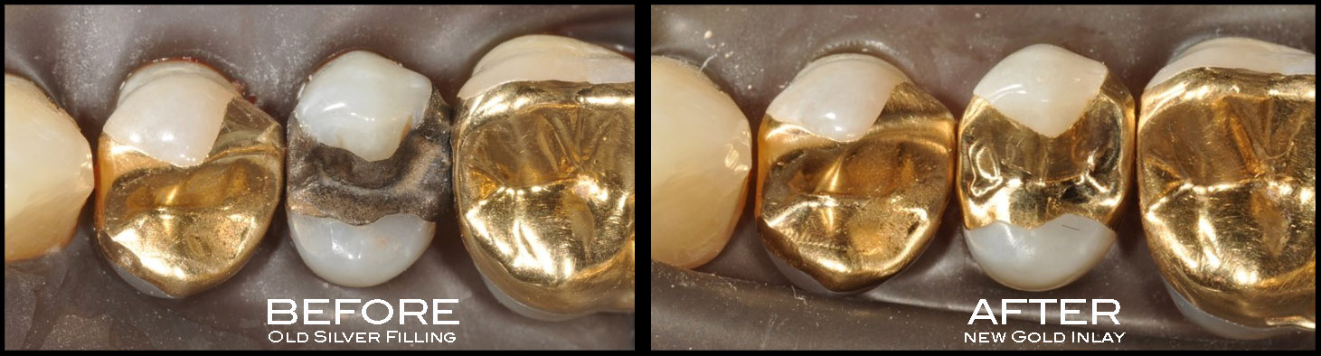 Tucker Gold Inlay & Crown
