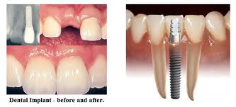 Dental Implant
