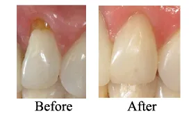 bonding before and after