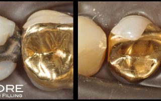 Tucker Gold Inlay & Crown