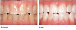 teeth whitening