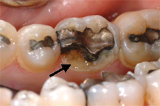 broken tooth