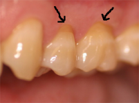 Gum line recession