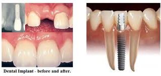 Dental Implant